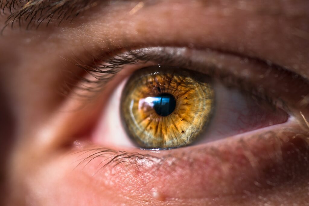 Eye bulging.jpg